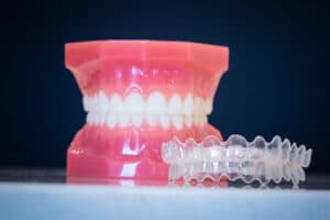 Are Clear Aligners Effective for Severe Cases?
