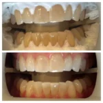 Cavities on Front Teeth: The Hidden Impact on Confidence and Smile Health 1 Teeth Whitening Specials 435-