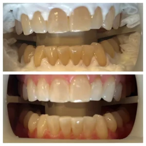 Cavities on Front Teeth: The Hidden Impact on Confidence and Smile Health