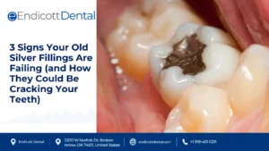 3 Signs Your Old Silver Fillings Are Failing (and How They Could Be Cracking Your Teeth)